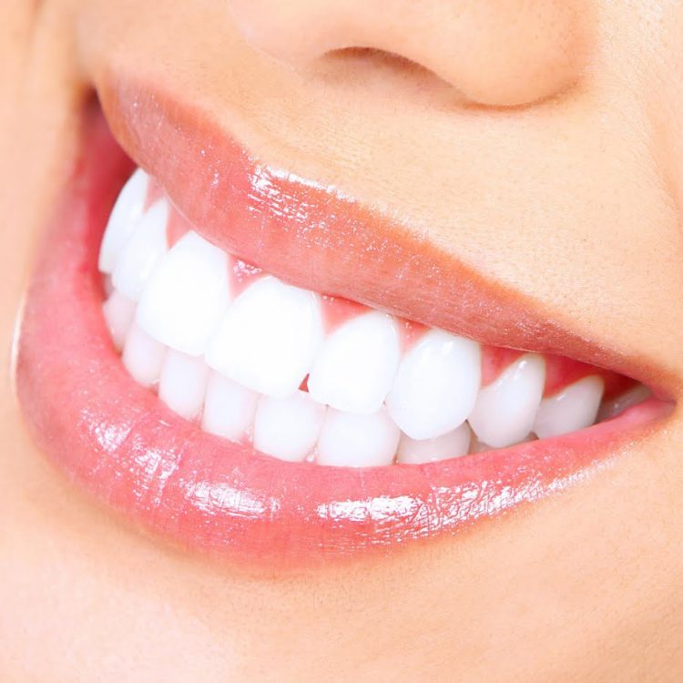 teeth-whitening