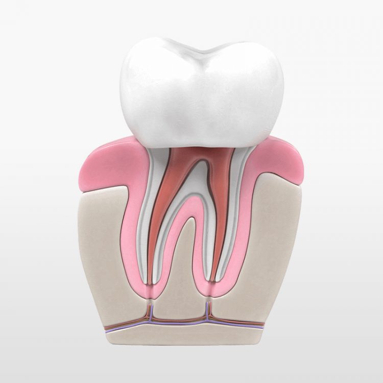 root-canal