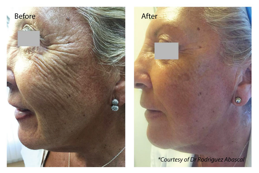 Injectable Moisturiser  Petts Wood
