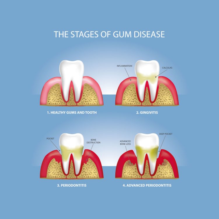Stages of Gum DIsease