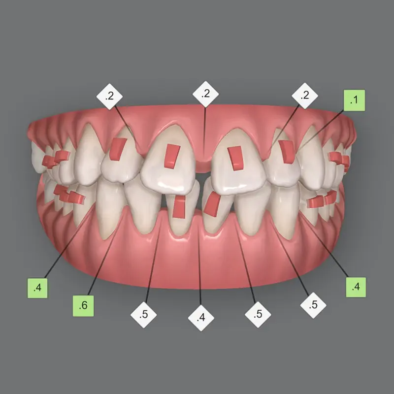 2 - Invisalign Clincheck Simulation Orpington