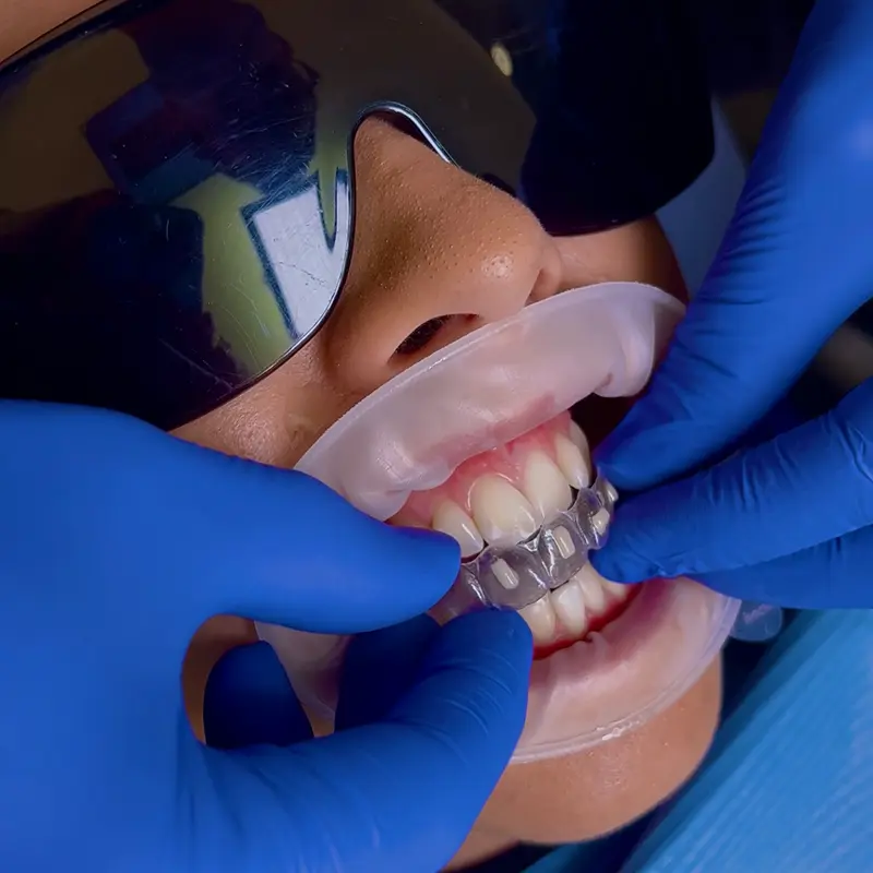 3 - Invisalign Fitting Orpington