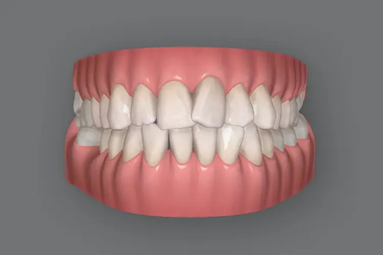 Full Invisalign Bromley