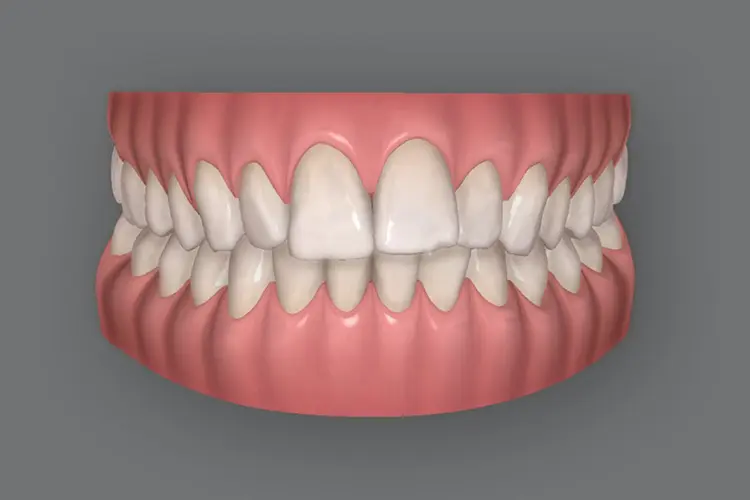 Lite Invisalign Bromley