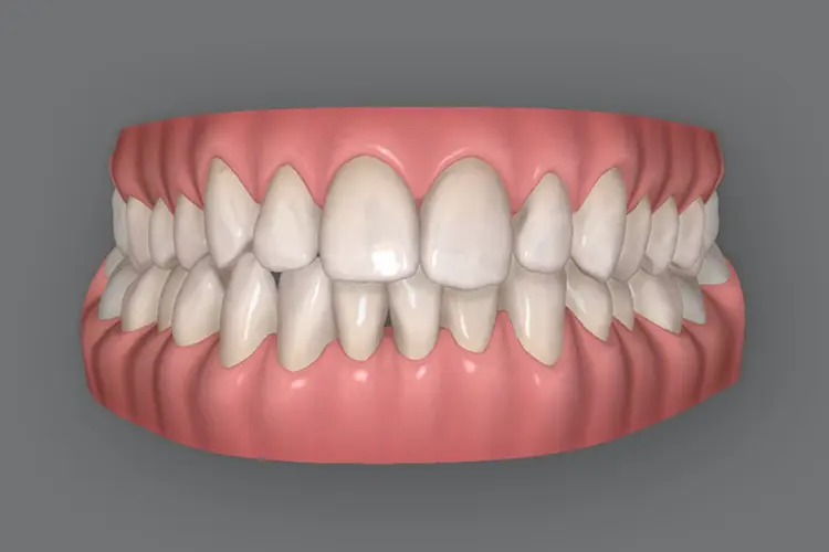 Moderate Invisalign Bromley